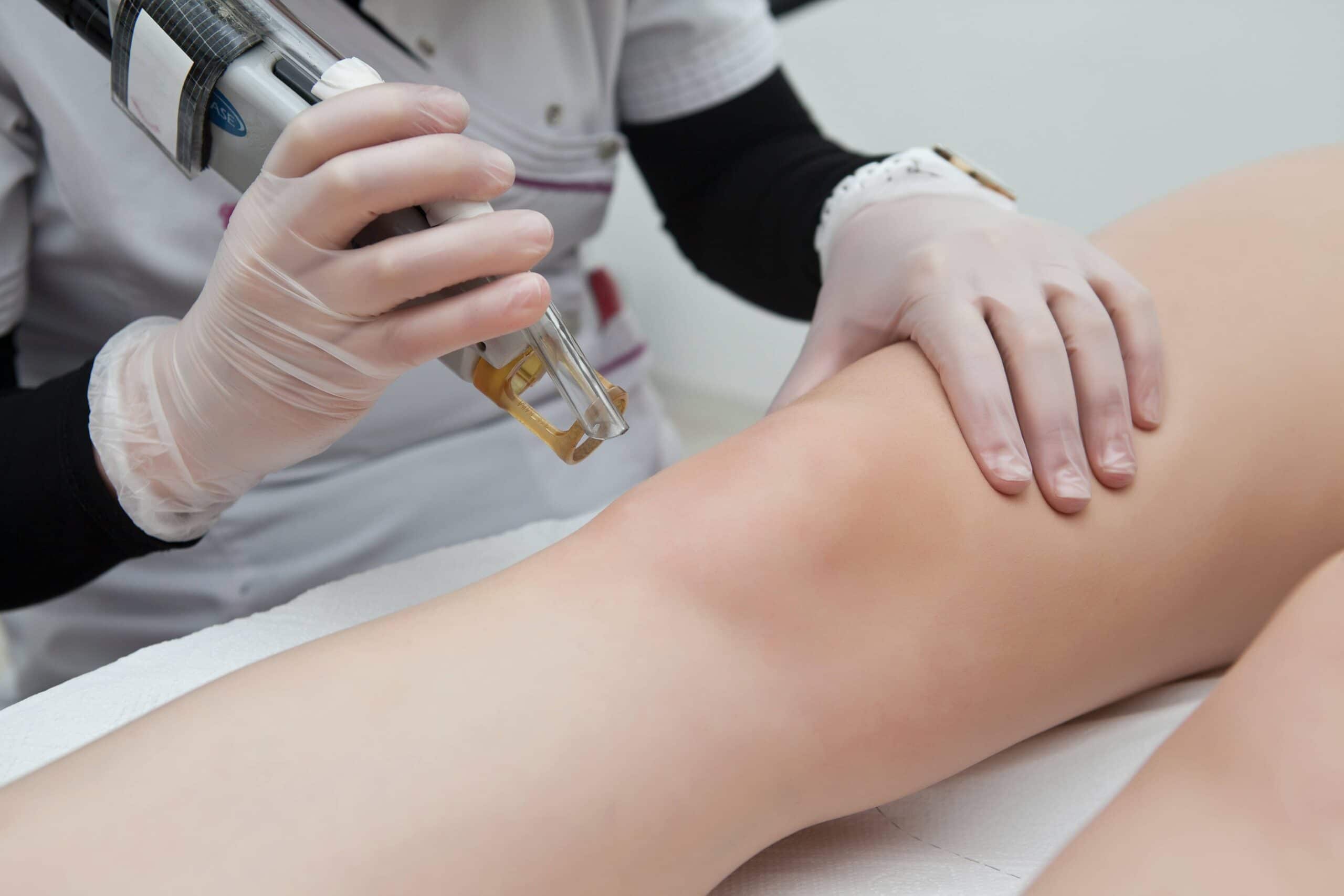 Epilation longue durée et définitive : quel laser choisir ?